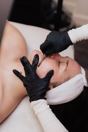dermaplanning